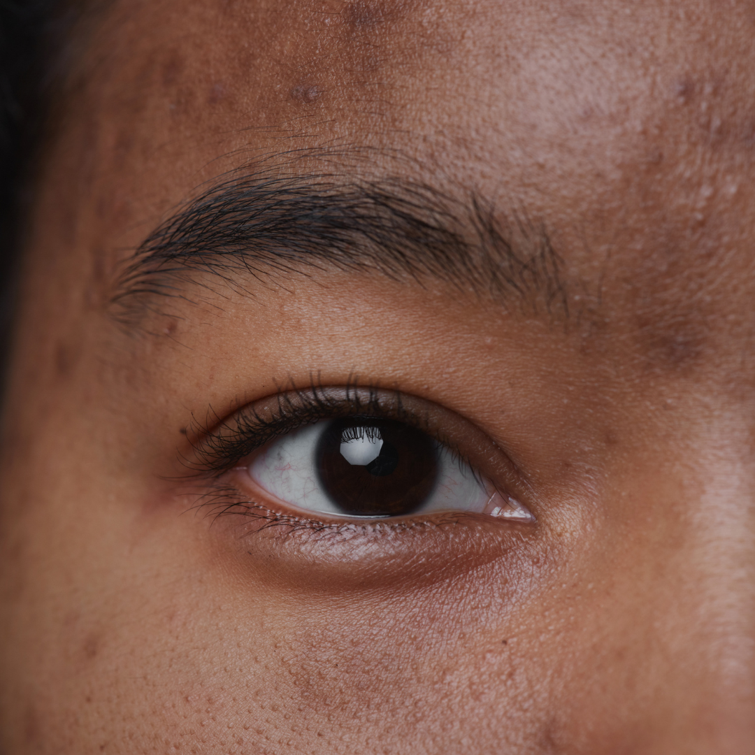 Comment lutter contre l’hyperpigmentation ?